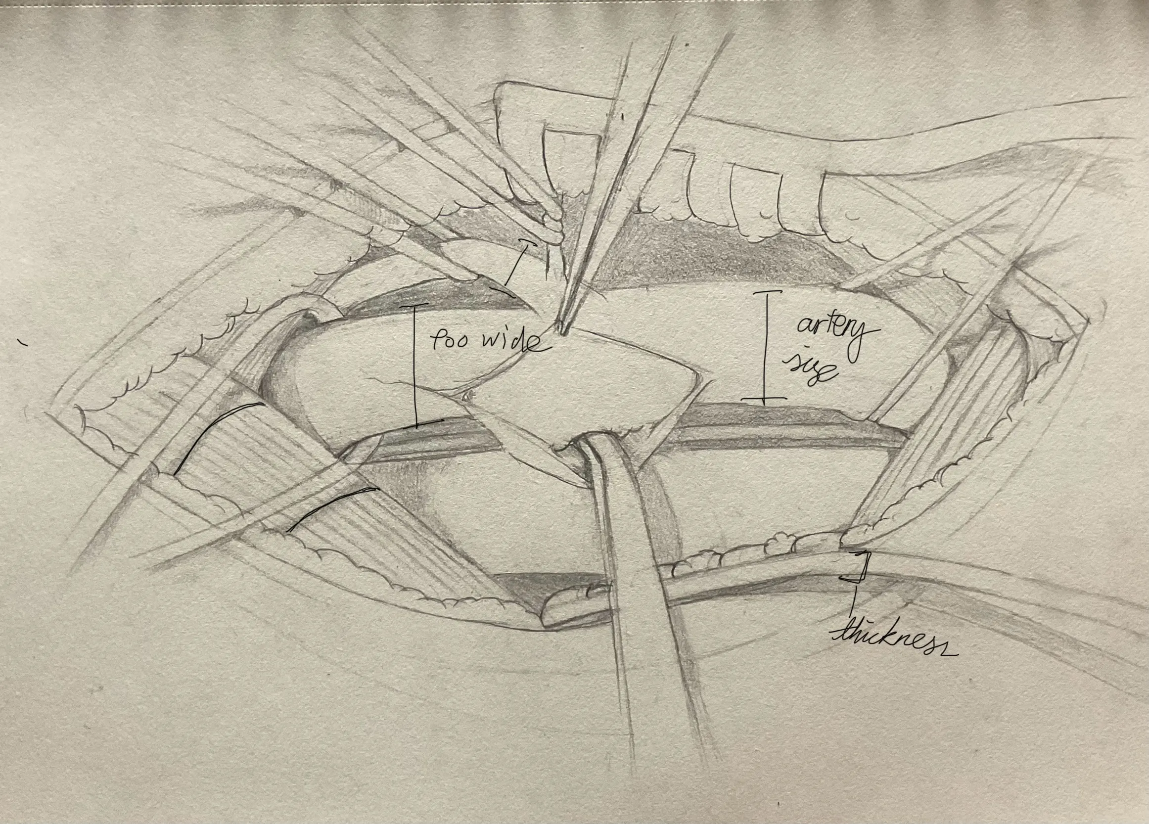 Preliminary pencil sketch for the carotid endarterectomy illustration