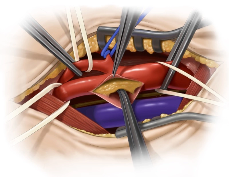 Carotid Endarterectomy - Photoshop
