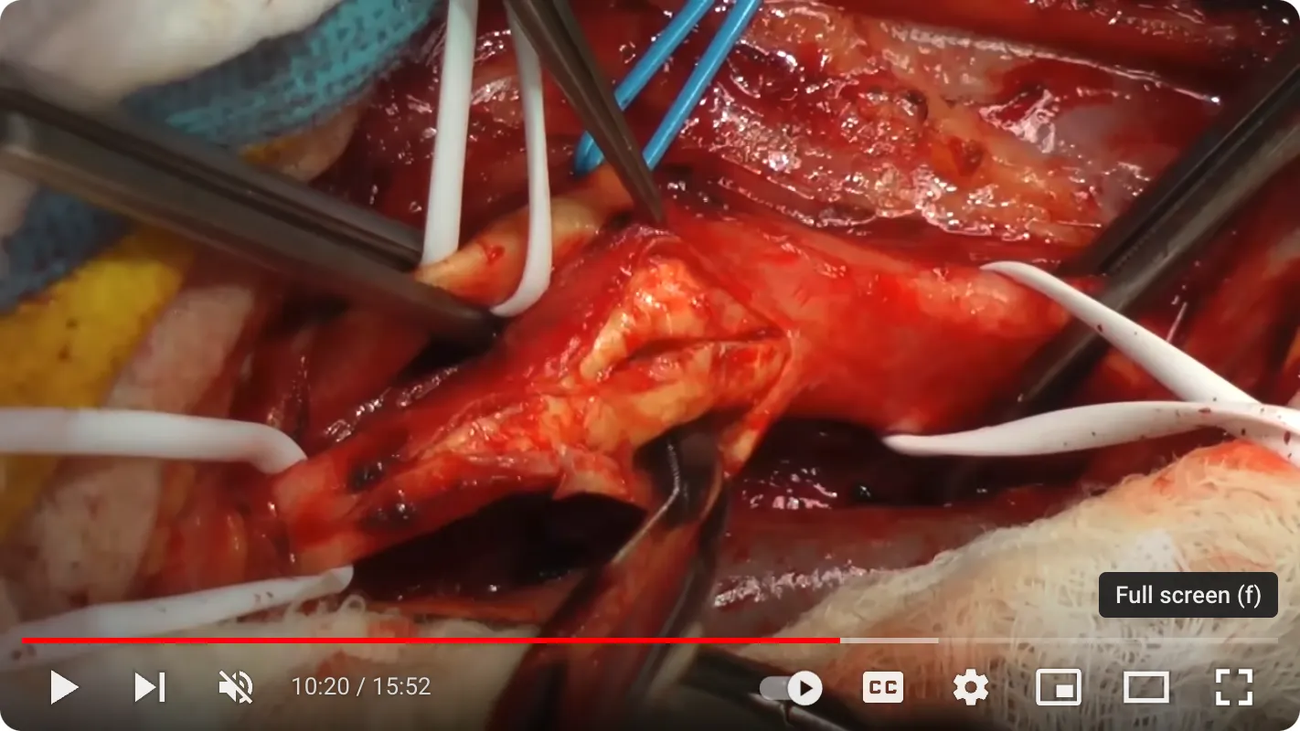 YouTube reference - The Mount Sinai Surgical Film Atlas: Carotid Endarterectomy