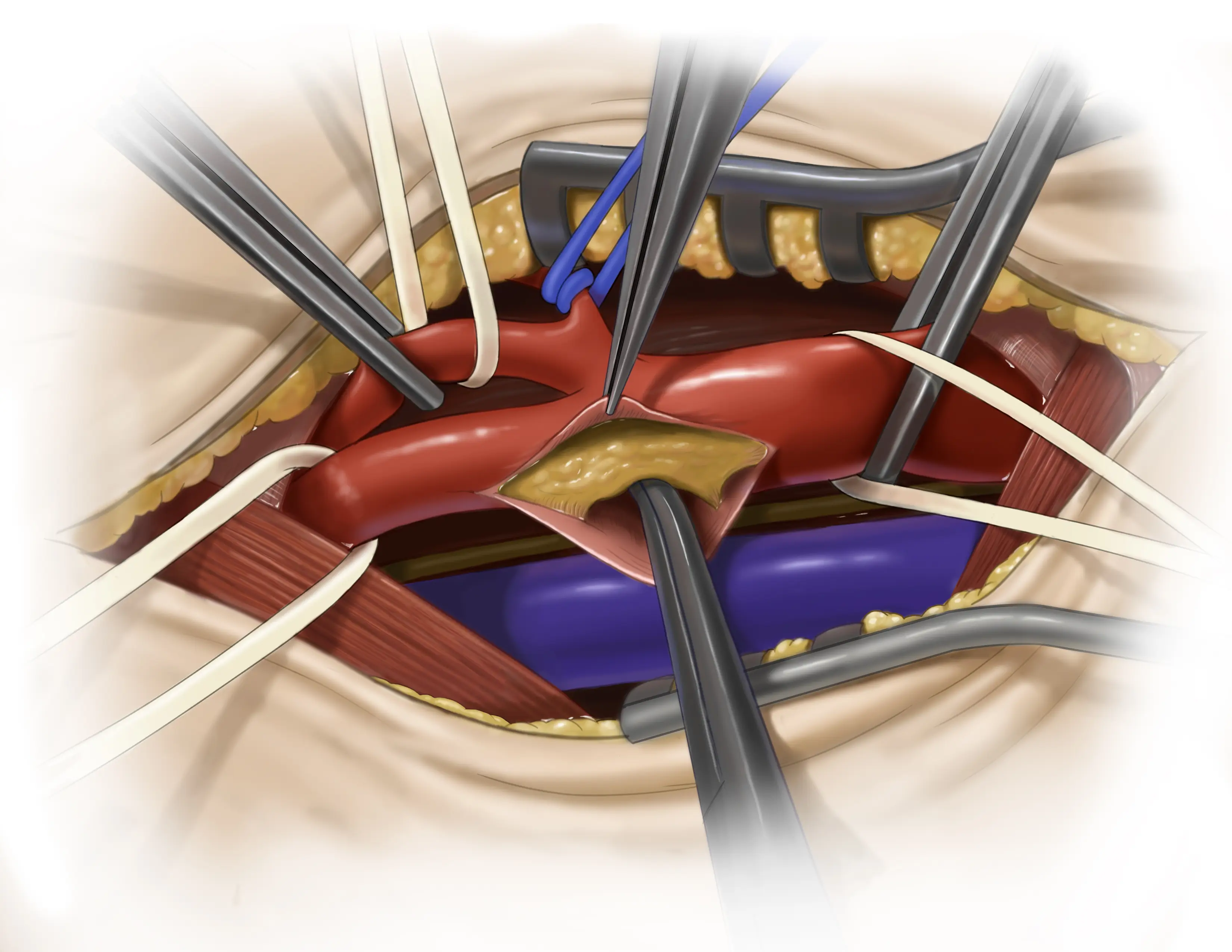 Carotid Endarterectomy - Photoshop, 2024