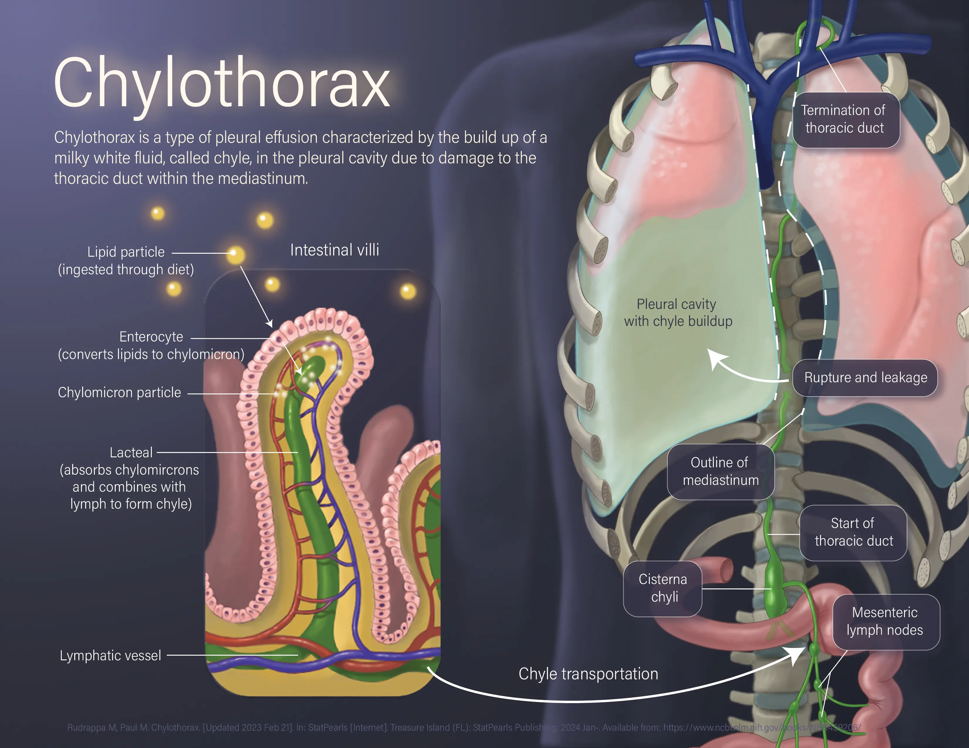 Chylothorax - Illustrator, Photoshop, Maya, 2024