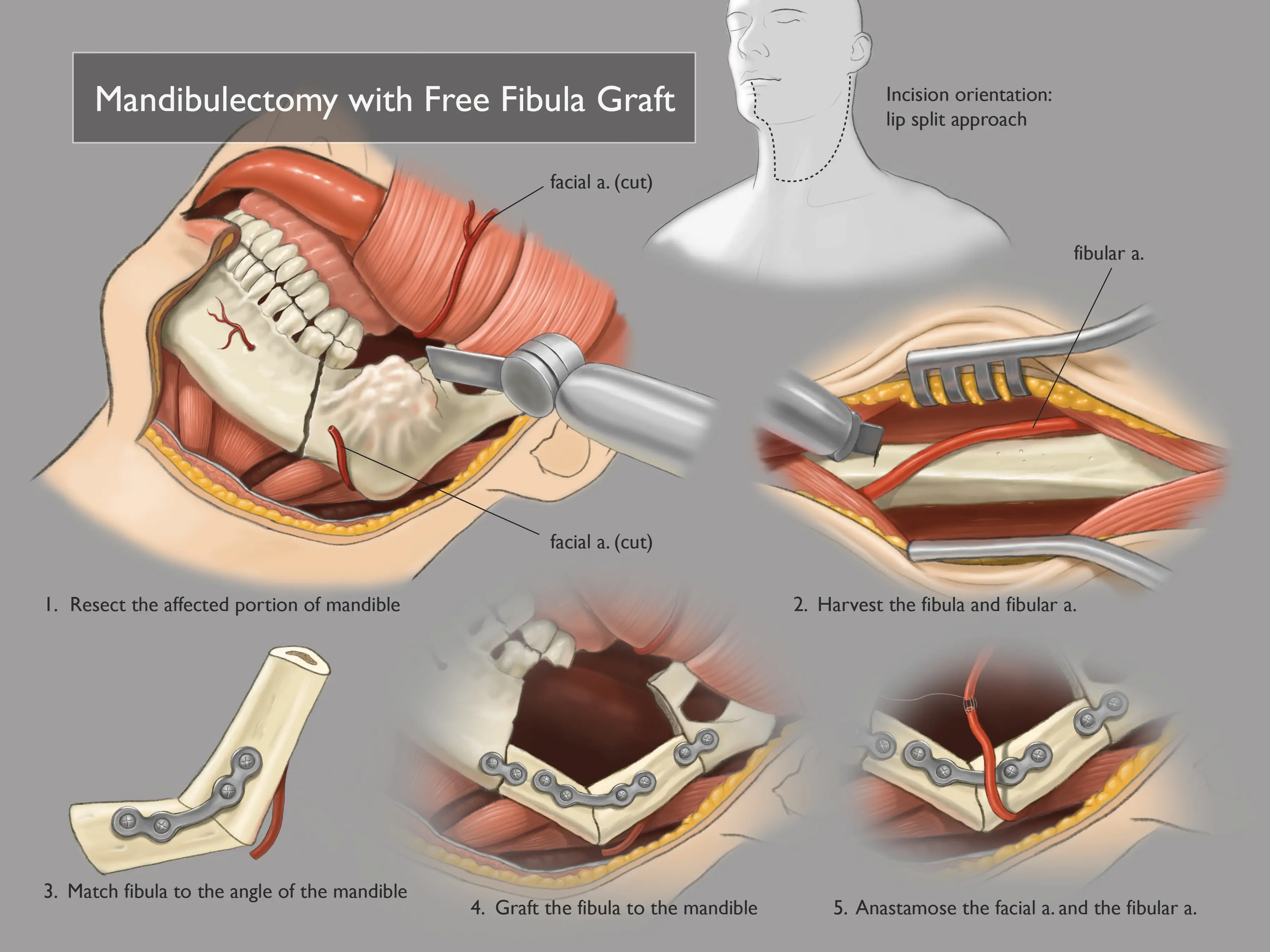 Mandibulectomy Illustration - Photoshop, 2024