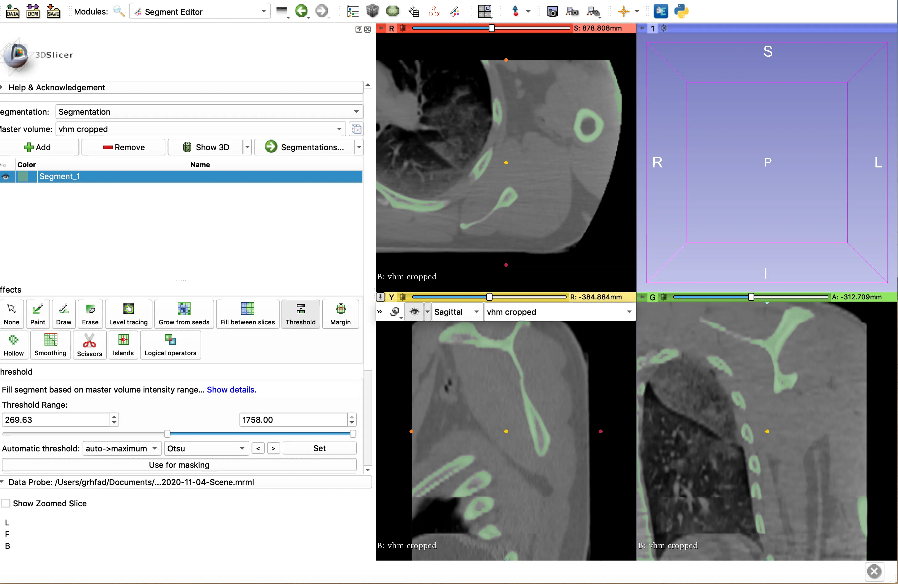 3D Slicer segmentation of the scapula from MRI data